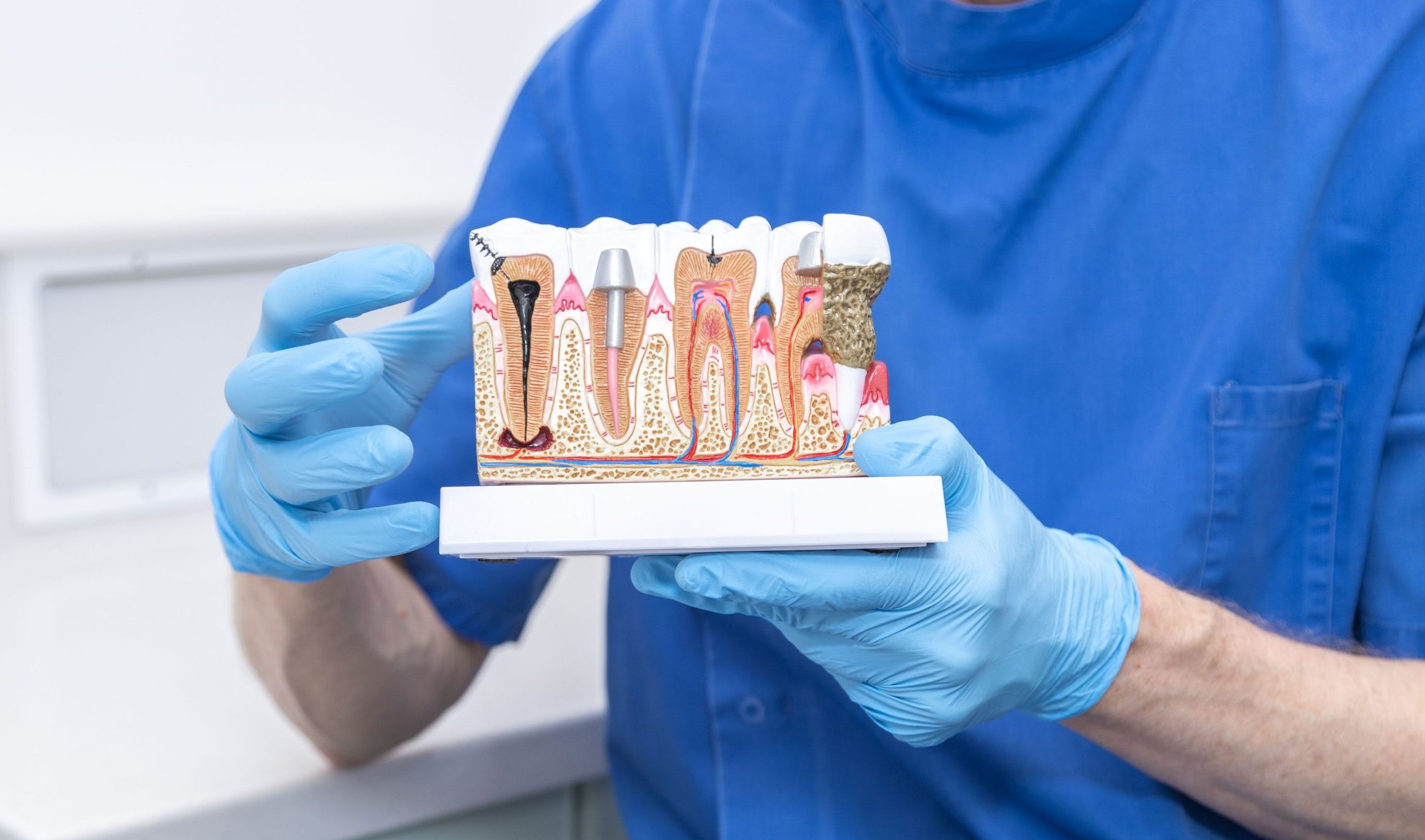 Root Canal Treatment