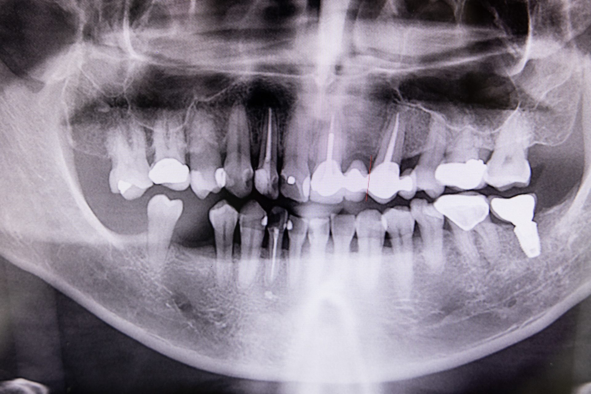 Root Canal Treatment